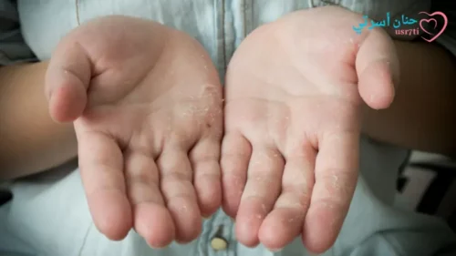 أسباب تقشير البشرة الجافة