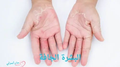 البشرة الجافة