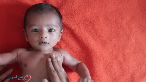 سوء التغذية عند الأطفال الرضع الأسباب، الأعراض، والعلاج